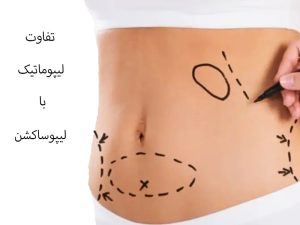تفاوت لیپوساکشن و لیپوماتیک