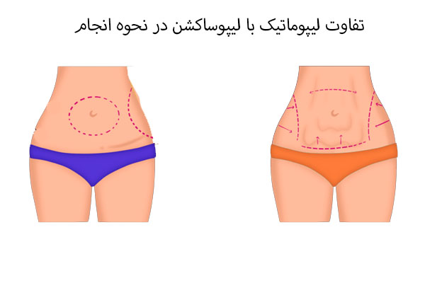 تفاوت لیپوماتیک با لیپوساکشن در نحوه انجام