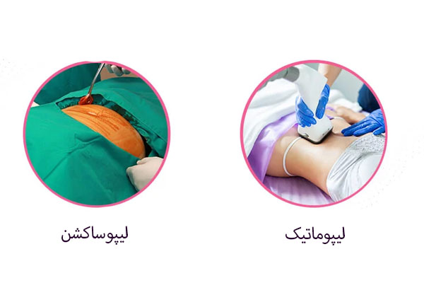 تفاوت لیپوماتیک با لیپوساکشن