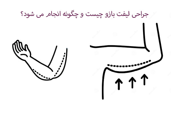 جراحی لیفت بازو