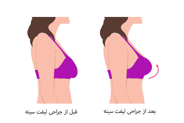 قبل و بعد از جراحی لیفت سینه