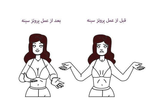 قبل و بعد از جراحی پروتز سینه
