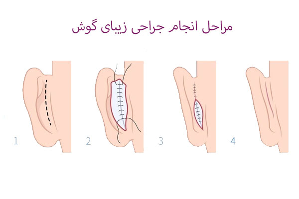 مراحل انجام جراحی زیبای گوش