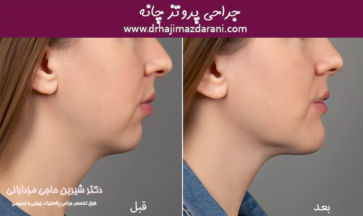 جراحی پروتز چانه