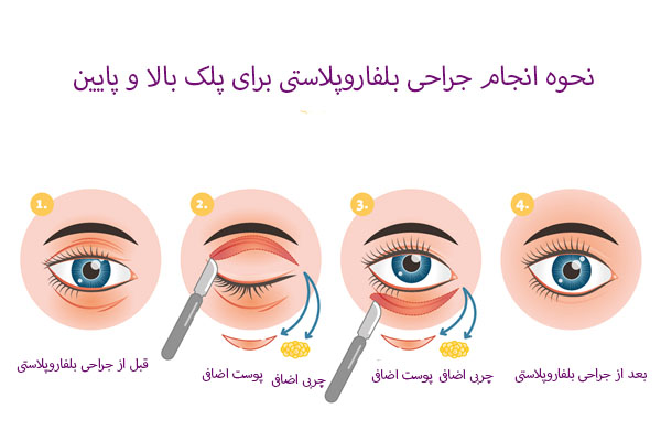 نحوه انجام جراحی بلفاروپلاستی