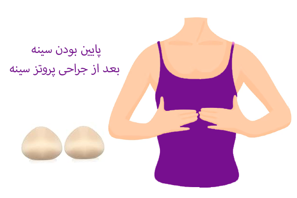 پایین بودن سینه بعد از جراحی پروتز سینه