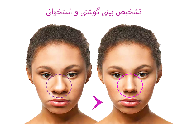 تشخیص بینی گوشتی و استخوانی
