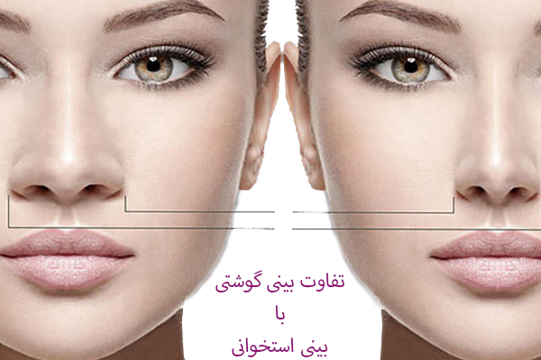 تفاوت بینی استخوانی با گوشتی