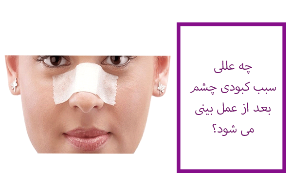علل کبودی چشم بعد از جراحی بینی