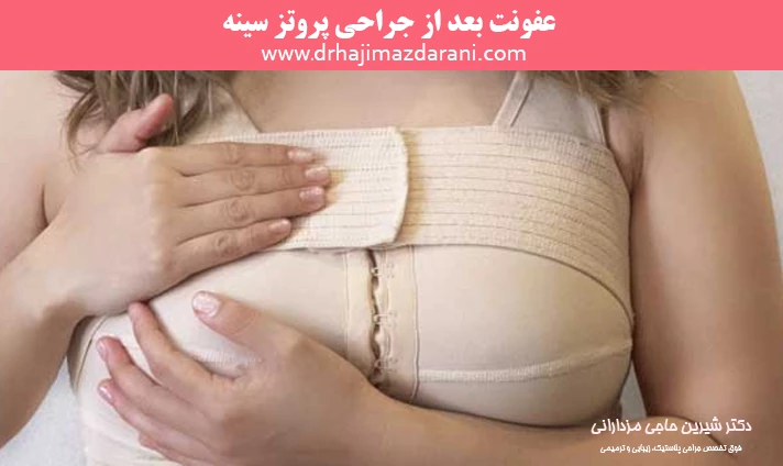 عفونت بعد از جراحی پروتز سینه