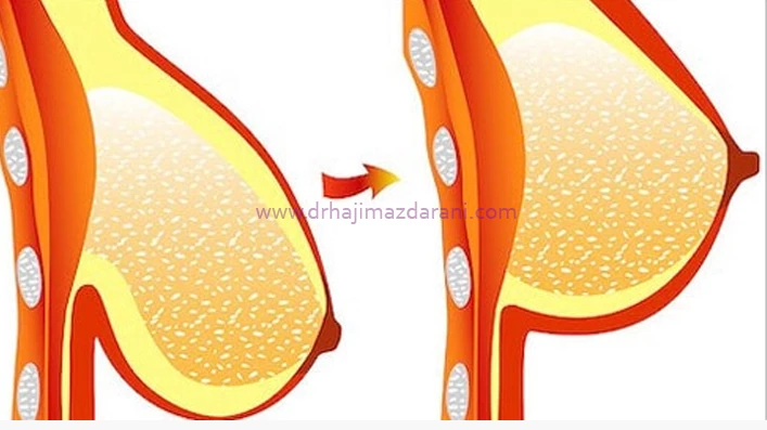 مزایای جراحی ماموپلاستی