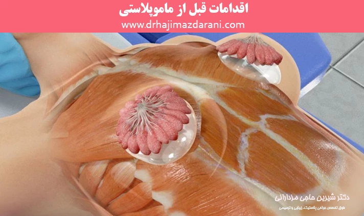 اقدامات قبل از ماموپلاستی