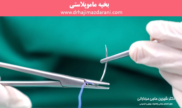 بخیه ماموپلاستی
