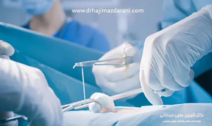 مراقبت از بخیه ماموپلاستی