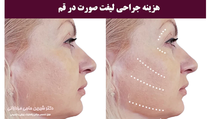هزینه جراحی لیفت صورت در قم