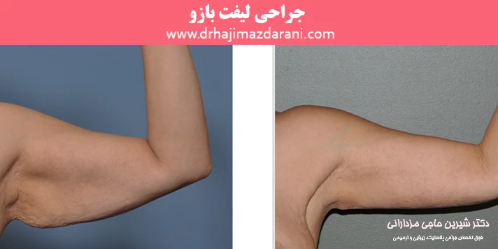جراحی لیفت بازو