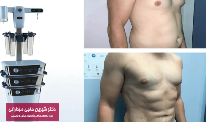 نحوه انجام لیپوماتیک با دستگاه پال