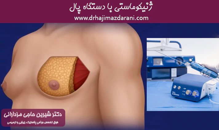 ژنیکوماستی با دستگاه پال