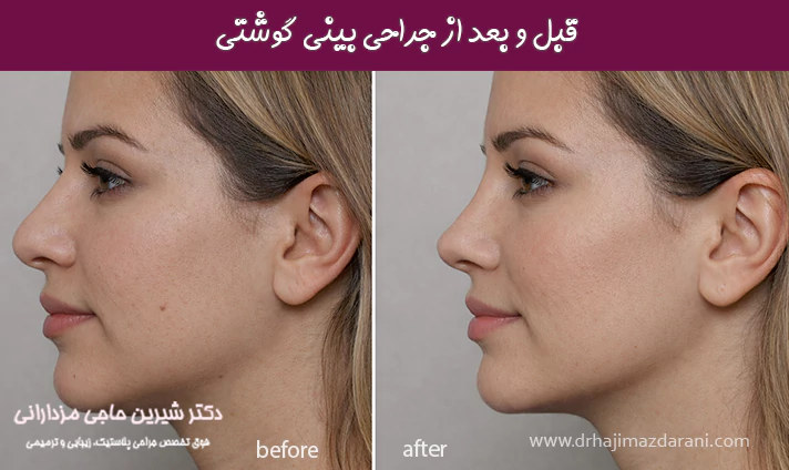 قبل و بعد از جراحی بینی گوشتی